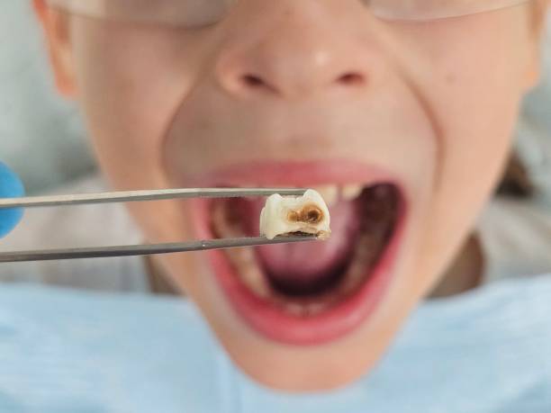 Best Broken or Cracked Tooth Emergency Dentist in Berea, OH